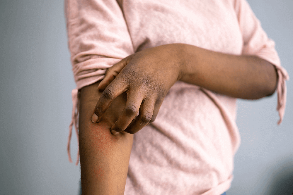 Dermatitis